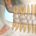 Dente Siso (Complicação na Arcada)